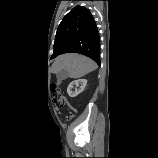 Aortic intramural hematoma (type B) (Radiopaedia 79323-92387 H 7).jpg