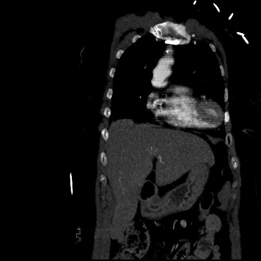 File:Aortic intramural hematoma from penetrating atherosclerotic ulcer (Radiopaedia 31137-31836 C 14).jpg