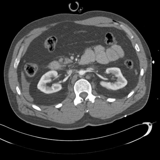 Aortic transection, diaphragmatic rupture and hemoperitoneum in a complex multitrauma patient (Radiopaedia 31701-32622 A 107).jpg