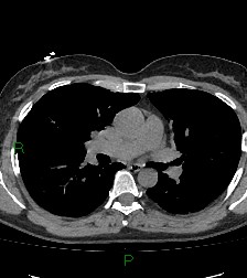 Aortic valve endocarditis (Radiopaedia 87209-103485 Axial non-contrast 48).jpg