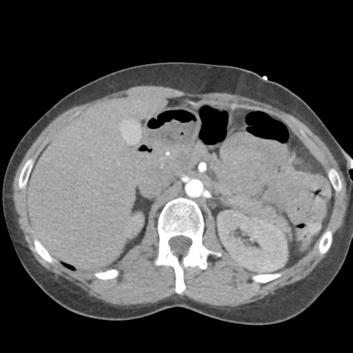 Aortic valve non-coronary cusp thrombus (Radiopaedia 55661-62189 B 55).png