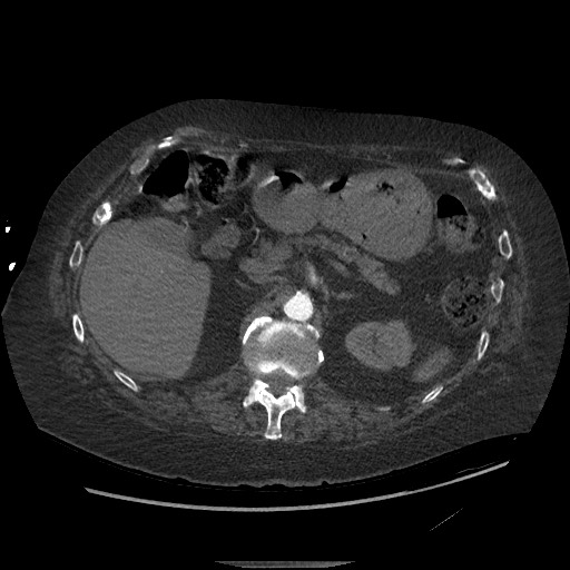 Aortoesophageal fistula with endovascular repair (Radiopaedia 73781-84592 Axial C+ CTPA 199).jpg
