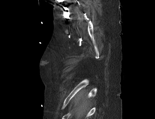 Aortoesophageal fistula with endovascular repair (Radiopaedia 73781-84592 Sagittal C+ CTPA 1).jpg