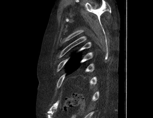 Aortoesophageal fistula with endovascular repair (Radiopaedia 73781-84592 Sagittal C+ CTPA 183).jpg