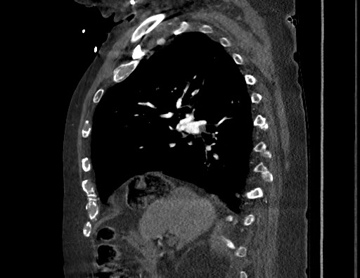 Aortoesophageal fistula with endovascular repair (Radiopaedia 73781-84592 Sagittal C+ CTPA 70).jpg