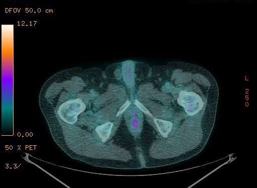 Appendiceal adenocarcinoma complicated by retroperitoneal abscess (Radiopaedia 58007-65041 Axial PET-CT 197).jpg
