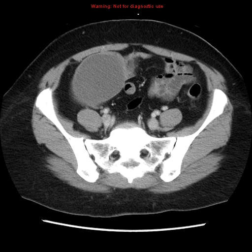 Appendiceal mucinous cystadenoma (Radiopaedia 8263-9111 Axial liver window 60).jpg
