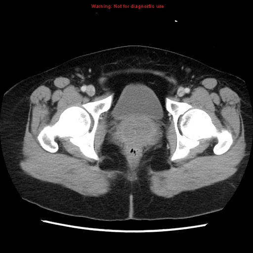 Appendiceal mucinous cystadenoma (Radiopaedia 8263-9111 Axial liver window 78).jpg