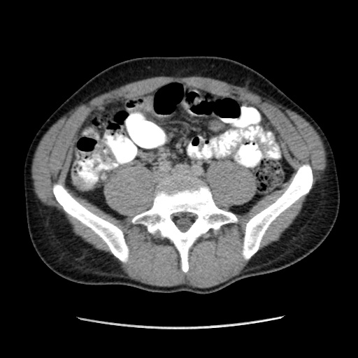 Appendicitis complicated by post-operative collection (Radiopaedia 35595-37113 A 48).jpg