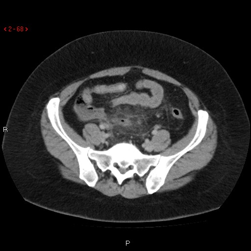 File:Appendicitis with microperforation- promontoric type (Radiopaedia 27268-27442 C 56).jpg