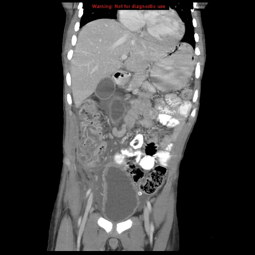 File:Appendicitis with phlegmon (Radiopaedia 9358-10046 B 24).jpg