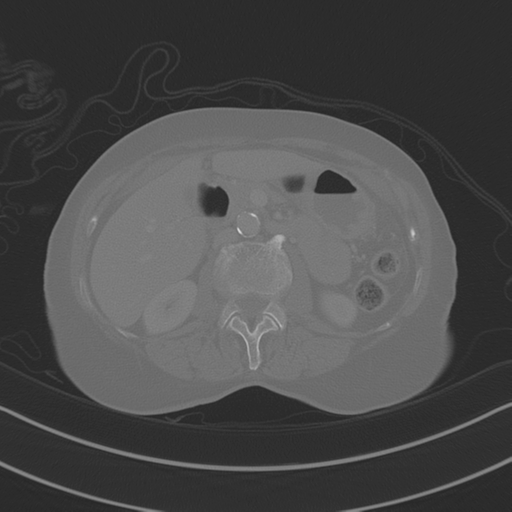 April fools' 2019- calcified peritoneal arachnoidosis (Radiopaedia 67273-76636 Axial bone window 14).png