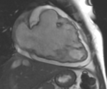 Arrhythmogenic right ventricular cardiomyopathy (Radiopaedia 69431-79307 2ch cine 77).jpg