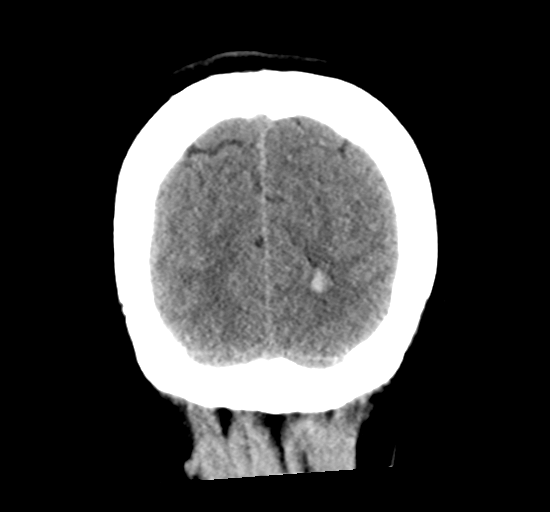 File:Arteriovenous malformation (cerebral) (Radiopaedia 40070-42579 Coronal non-contrast 34).png