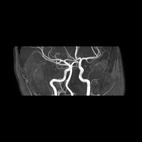 File:Artery of Percheron infarct (Radiopaedia 40966-43676 G 24).jpg