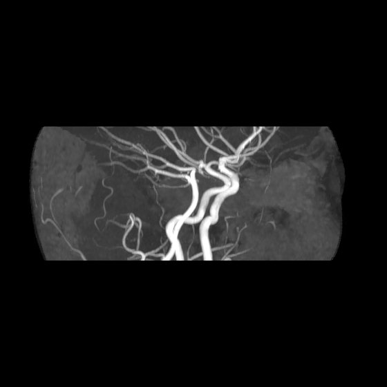 File:Artery of Percheron infarct (Radiopaedia 40966-43676 G 6).jpg
