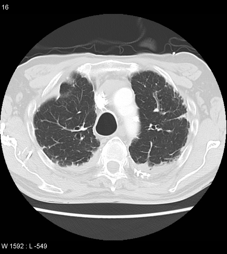 Asbestos related lung and pleural disease (Radiopaedia 14377-14301 A 13).jpg