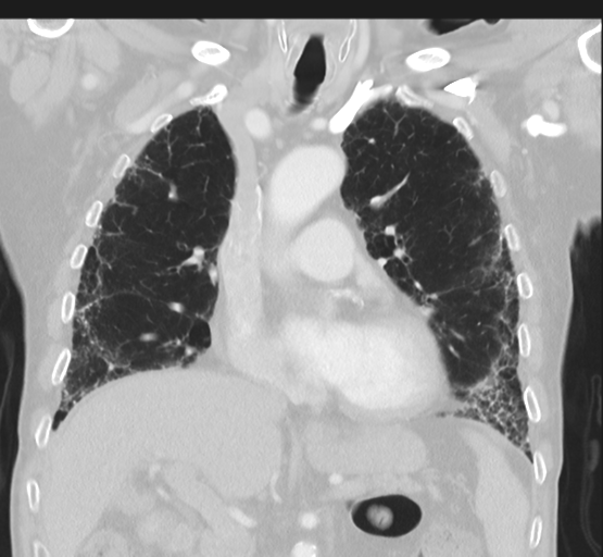 Asbestosis (Radiopaedia 56192-62864 Coronal lung window 22).png