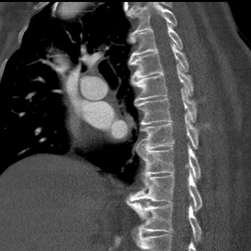 File:Ascending aortic aneurysm (Radiopaedia 20913-20846 A 28).jpg