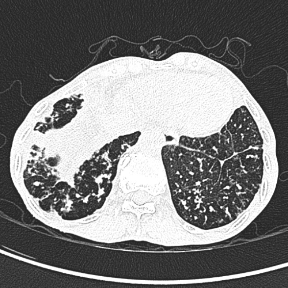 Aspergilloma- with Monod sign (Radiopaedia 44737-48532 Axial lung window 252).jpg