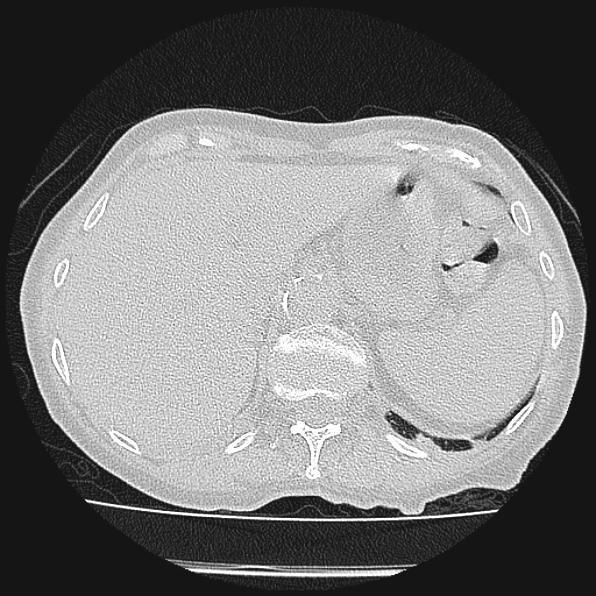 Aspergilloma (Radiopaedia 24458-24763 Axial lung window 66).jpg