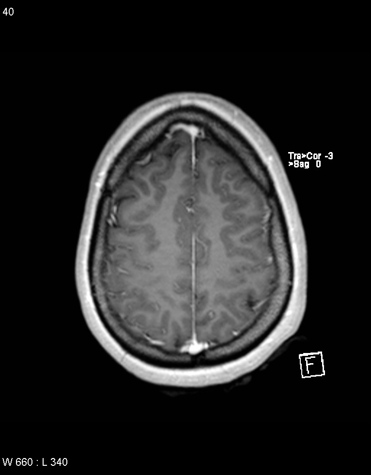 Astroblastoma (Radiopaedia 39792-42218 Axial T1 C+ 39).jpg