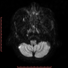Astroblastoma (Radiopaedia 74287-85162 Axial DWI 9).jpg