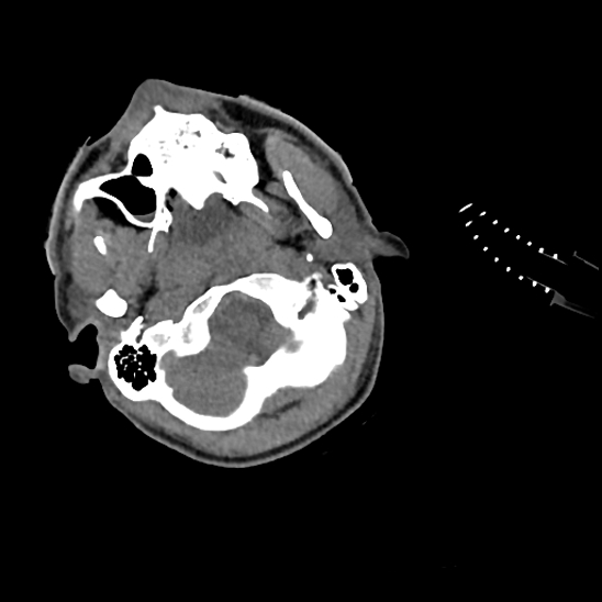 File:Atlanto-occipital dissociation (Traynelis type 1), C2 teardrop fracture, C6-7 facet joint dislocation (Radiopaedia 87655-104061 Axial non-contrast 5).jpg