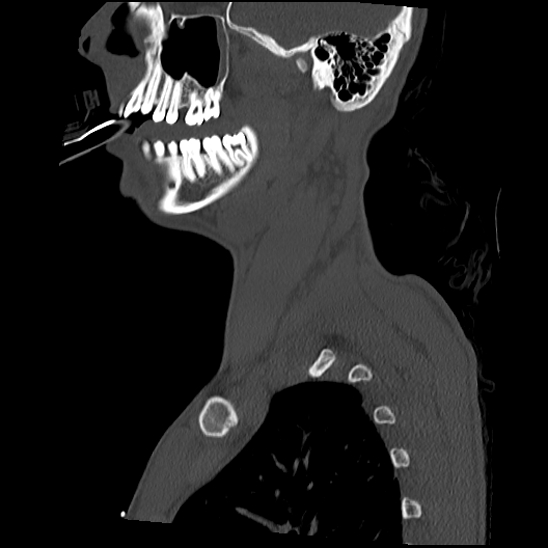 Atlanto-occipital dissociation (Traynelis type 1), C2 teardrop fracture, C6-7 facet joint dislocation (Radiopaedia 87655-104061 Sagittal bone window 12).jpg