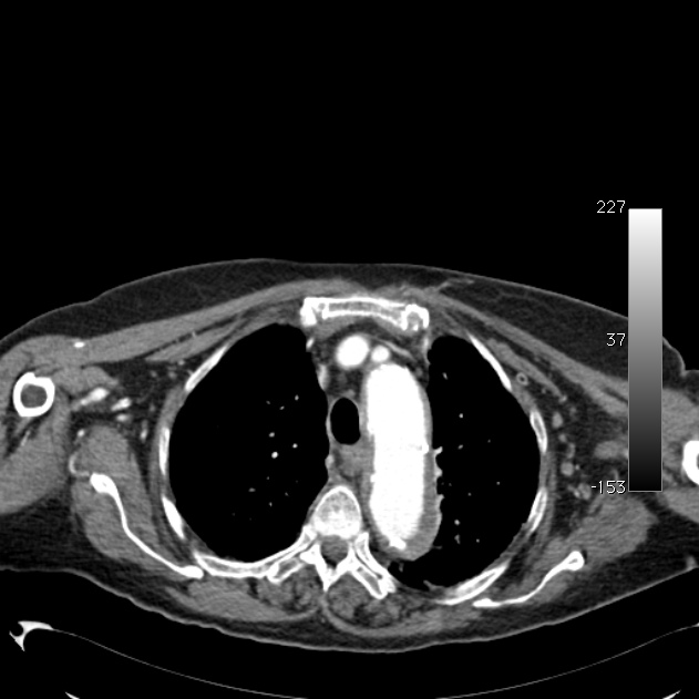 Atypical dissection of the thoracic aorta (Radiopaedia 10975-11393 A 15).jpg