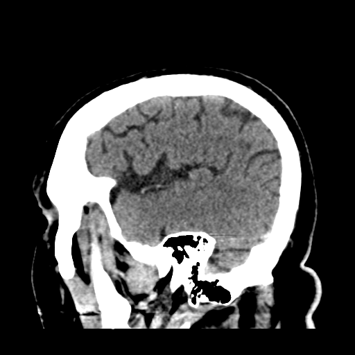 Atypical meningioma (WHO grade II) with brain invasion (Radiopaedia 57767-64728 Sagittal C+ 42).png