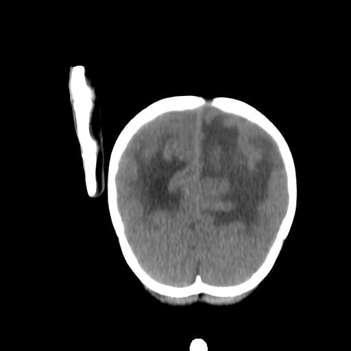 Atypical teratoid rhabdoid tumor (AT-RT) (Radiopaedia 85823-101654 Coronal non-contrast 46).jpg