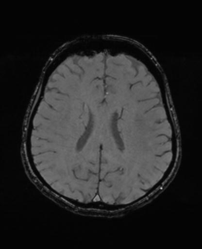 Autoimmune limbic encephalitis (Radiopaedia 30363-31005 SWI - magnitude 50).jpg