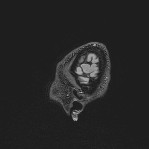 Autoimmune limbic encephalitis (Radiopaedia 30363-31005 Sagittal FLAIR 145).jpg