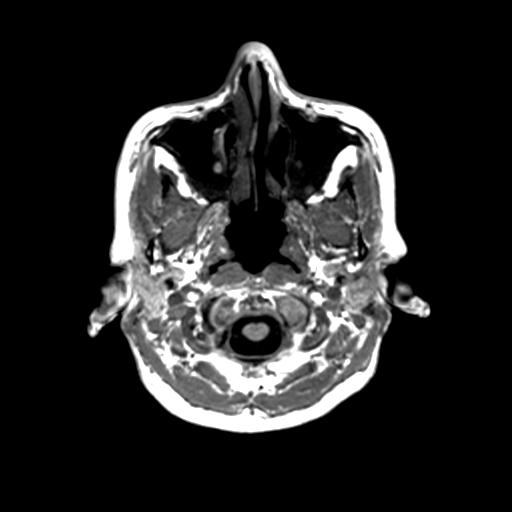 Autoimmune limbic encephalitis (Radiopaedia 30363-31005 T1 Axial 1mm 14).jpg