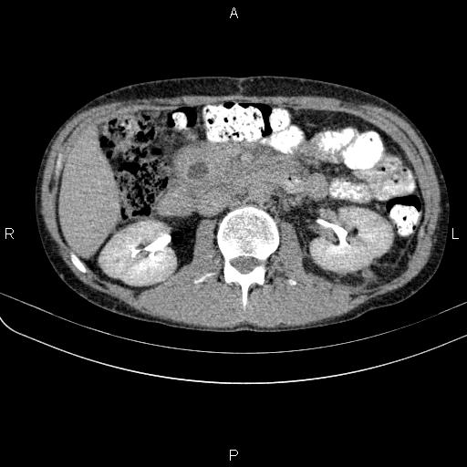 File:Autoimmune pancreatitis (Radiopaedia 84925-100431 Axial C+ delayed 33).jpg