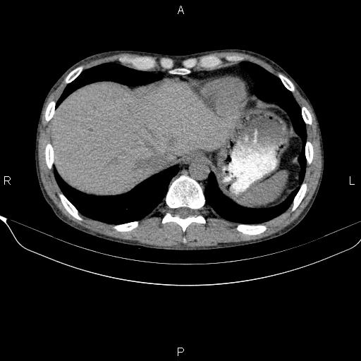 Autoimmune pancreatitis (Radiopaedia 84925-100431 Axial non-contrast 8).jpg