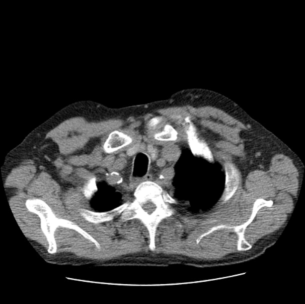 Autosomal dominant polycystic kidney disease (Radiopaedia 27851-28094 Axial non-contrast 6).jpg