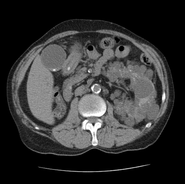 Autosomal dominant polycystic kidney disease (Radiopaedia 27851-28094 Axial non-contrast 70).jpg