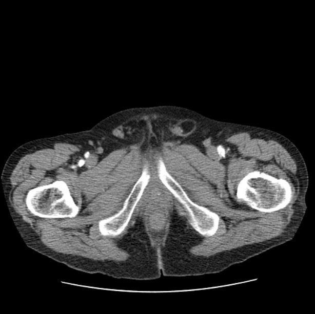 Autosomal dominant polycystic kidney disease (Radiopaedia 27851-28094 B 126).jpg