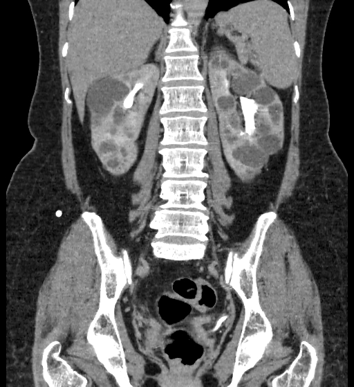Autosomal dominant polycystic kidney disease (Radiopaedia 38189-40194 Coronal C+ delayed 67).jpg