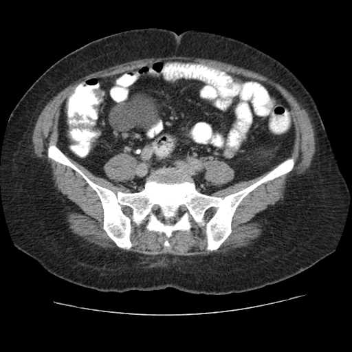 Autosomal dominant polycystic kidney disease with hepatic involvement (Radiopaedia 32693-33662 C 58).jpg