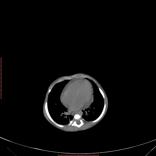 File:Autosomal recessive polycystic kidney disease associated with Caroli disease (Radiopaedia 61932-69984 Axial non-contrast 82).jpg