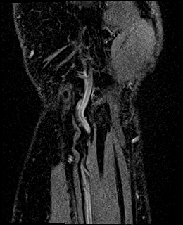 Avascular necrosis of the capitate (Radiopaedia 88317-104948 Coronal T1 vibe 84).jpg