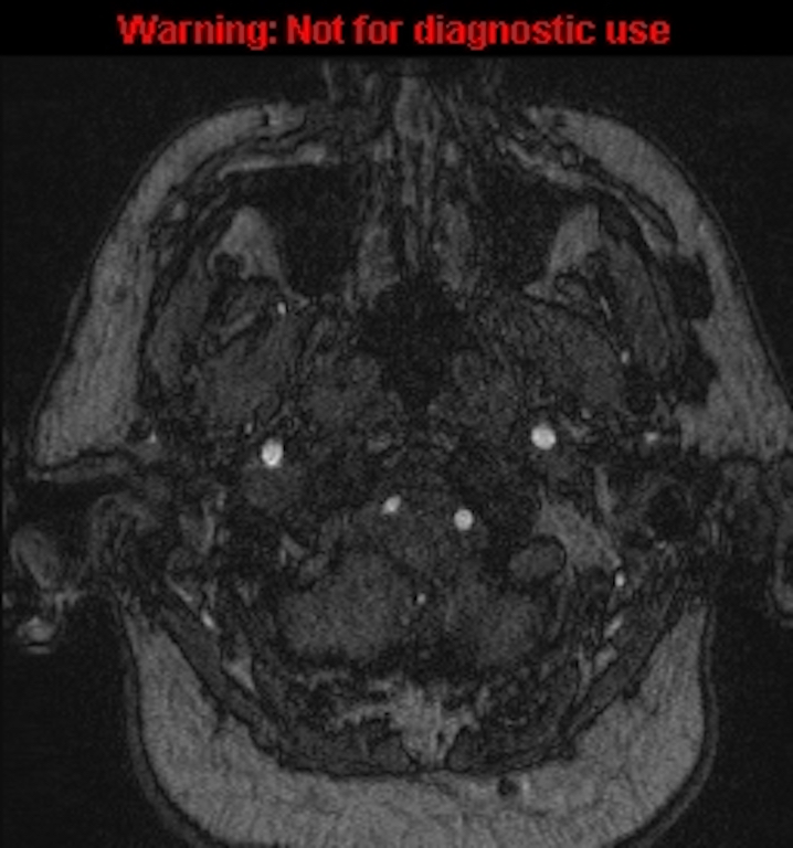Azygos anterior cerebral artery (Radiopaedia 59325-66677 Axial MRA 3).jpg