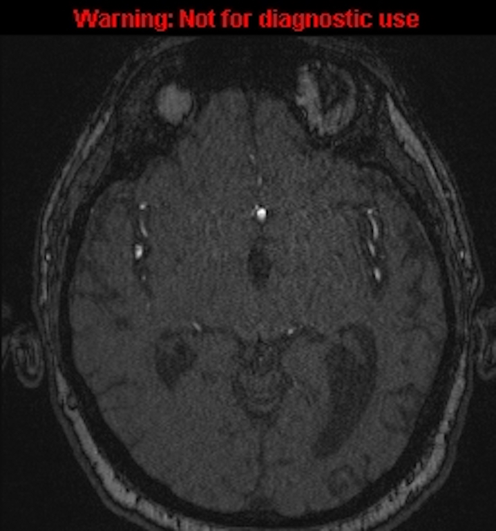Azygos anterior cerebral artery (Radiopaedia 59325-66677 Axial MRA 77).jpg