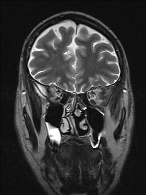 Balo concentric sclerosis (Radiopaedia 50458-55940 Coronal T2 14).jpg
