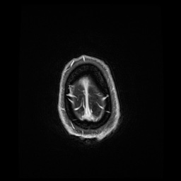 Balo concentric sclerosis (Radiopaedia 53875-59982 Axial LAVA C+ 247).jpg