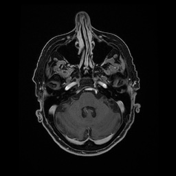 Balo concentric sclerosis (Radiopaedia 53875-59982 Axial LAVA C+ 65).jpg