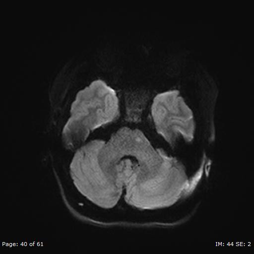 File:Balo concentric sclerosis (Radiopaedia 61637-69636 Axial DWI 40).jpg